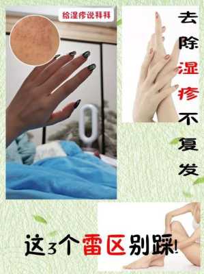孕期的湿疹怎么办啊(孕妇湿疹怎样快速止痒有什么好的办法的吗,快要用湿疹药膏的吗) 第2张 孕期的湿疹怎么办啊(孕妇湿疹怎样快速止痒有什么好的办法的吗,快要用湿疹药膏的吗) 第2张