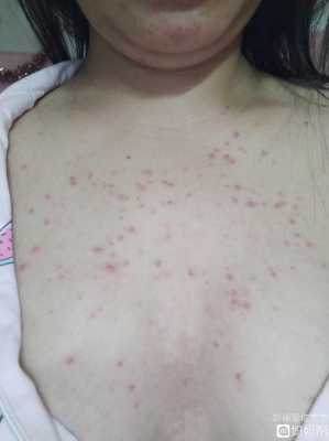 孕期起疙瘩(孕期起疙瘩怎么回事) 第3张 孕期起疙瘩(孕期起疙瘩怎么回事) 第3张
