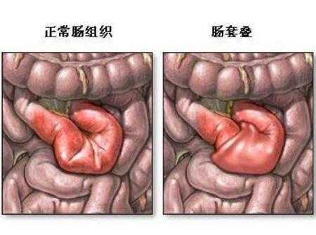 胎儿肠阻(胎儿肠阻梗用引产吗) 第1张 胎儿肠阻(胎儿肠阻梗用引产吗) 第1张