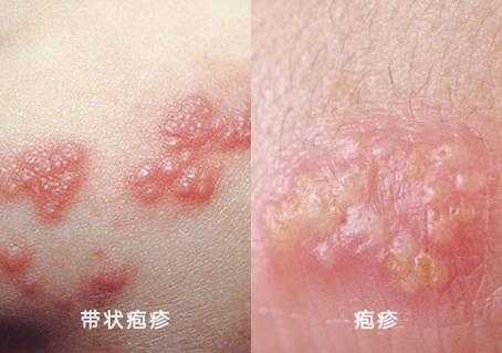 带状疱疹对胎儿的影响(带状疱疹对胎儿的影响) 第1张 带状疱疹对胎儿的影响(带状疱疹对胎儿的影响) 第1张