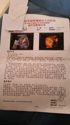 三维彩超结果怎么看,胎儿三维彩超图片好丑 第3张 三维彩超结果怎么看,胎儿三维彩超图片好丑 第3张