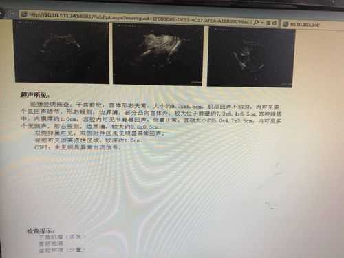 怀孕了,但查出有子宫肌瘤要紧吗,怀孕期间子宫肌瘤怎么办? 第3张 怀孕了,但查出有子宫肌瘤要紧吗,怀孕期间子宫肌瘤怎么办? 第3张