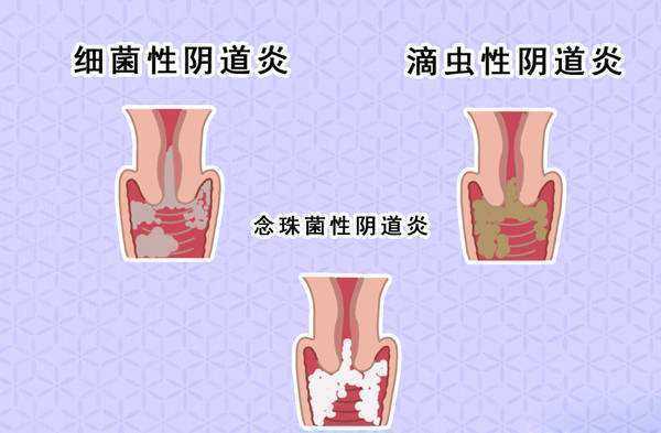 孕期阴道干(怀孕以后特别干涩是怎么回事) 第1张 孕期阴道干(怀孕以后特别干涩是怎么回事) 第1张