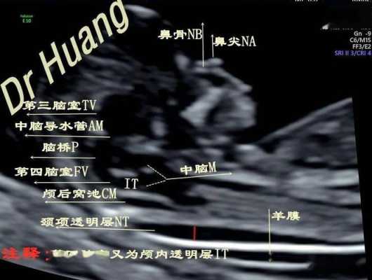 怎样让胎儿动起来(做nt怎样让胎儿动起来) 第2张 怎样让胎儿动起来(做nt怎样让胎儿动起来) 第2张