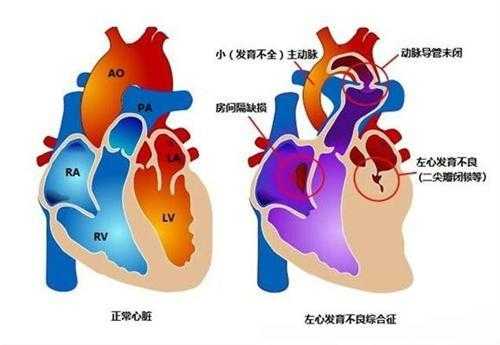 胎儿左心发育不良（胎儿左心发育不良还能要吗）  第1张