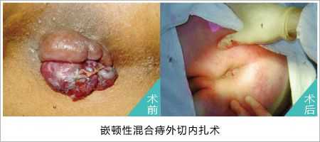 孕期痔疮能自愈吗(内外混合痔能自愈吗) 第2张 孕期痔疮能自愈吗(内外混合痔能自愈吗) 第2张