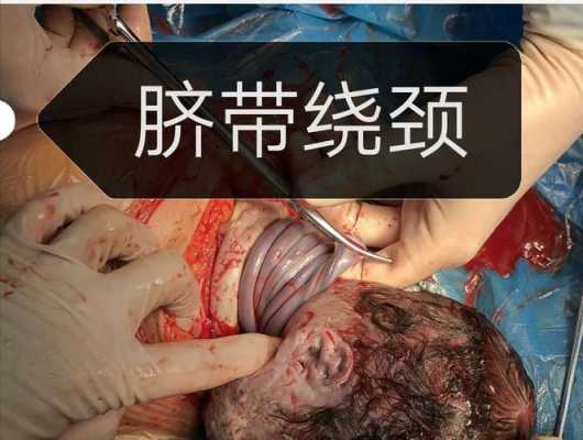 孕期脐带(孕期脐带绕颈有什么症状) 第3张 孕期脐带(孕期脐带绕颈有什么症状) 第3张