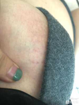 怀孕期间乳头痒怎么办(孕妇胸部瘙痒怎么治) 第3张 怀孕期间乳头痒怎么办(孕妇胸部瘙痒怎么治) 第3张
