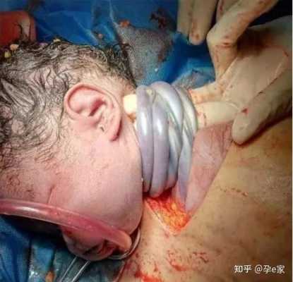 请问下大家宝宝脐带绕颈一周,有什么危险吗,胎儿脐带绕颈二圈会有危险吗 第2张 请问下大家宝宝脐带绕颈一周,有什么危险吗,胎儿脐带绕颈二圈会有危险吗 第2张