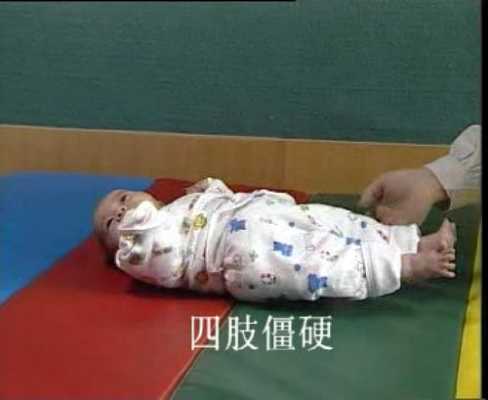 胎儿脑瘫会胎动吗,脑瘫胎儿时期可以筛查出来么 第1张 胎儿脑瘫会胎动吗,脑瘫胎儿时期可以筛查出来么 第1张