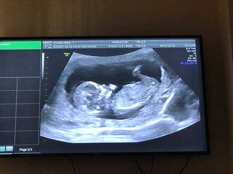 怀孕12周了孩子小怎么回事,胎儿十二周能看出男女吗 第2张 怀孕12周了孩子小怎么回事,胎儿十二周能看出男女吗 第2张