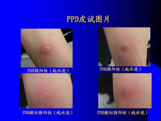 怀孕后能做肺结核皮试吗,孕期肺结核会影响胎儿吗 第1张 怀孕后能做肺结核皮试吗,孕期肺结核会影响胎儿吗 第1张