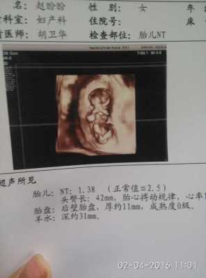 孕期nt是检查胎儿什么,NT是胎儿的什么 第3张 孕期nt是检查胎儿什么,NT是胎儿的什么 第3张