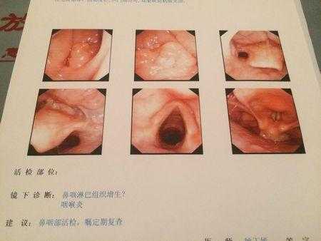 怀孕了老是感觉喉咙里有东西是怎么回事,孕期喉咙痛怎么解决 第2张 怀孕了老是感觉喉咙里有东西是怎么回事,孕期喉咙痛怎么解决 第2张