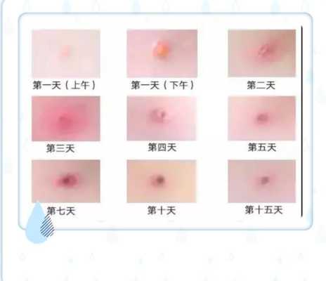 出水痘的危害有哪些,孕期水痘对胎儿的影响 第2张 出水痘的危害有哪些,孕期水痘对胎儿的影响 第2张