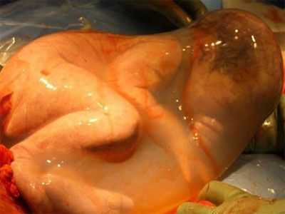 刨腹胎儿(剖腹产算生孩子吗) 第2张 刨腹胎儿(剖腹产算生孩子吗) 第2张