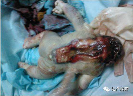 胎儿致死性畸形(胎儿致死性畸形) 第3张 胎儿致死性畸形(胎儿致死性畸形) 第3张