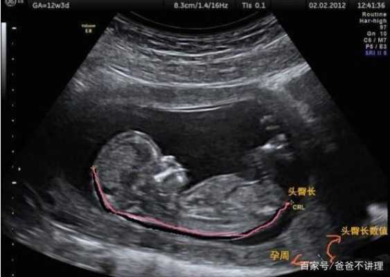 孕12周头臀径47mm正常吗,十二周的胎儿有多大图片  第2张