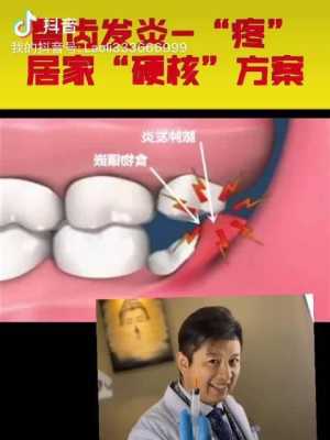 怀孕期间智齿发炎怎么办(智齿发炎了怎么能快速消炎) 第2张 怀孕期间智齿发炎怎么办(智齿发炎了怎么能快速消炎) 第2张