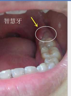 怀孕期间牙龈肿痛怎么办(怀孕12周了,牙疼的厉害,牙龈肿起来了,怎么办) 第2张 怀孕期间牙龈肿痛怎么办(怀孕12周了,牙疼的厉害,牙龈肿起来了,怎么办) 第2张
