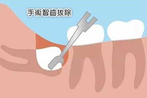 备孕期间可以拔智齿吗(备孕期间可以拔智齿吗) 第2张 备孕期间可以拔智齿吗(备孕期间可以拔智齿吗) 第2张