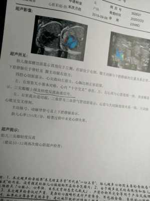 胎儿25周四维彩超显示三尖瓣少量反流,其它正常,25周胎儿四维彩超图 第2张 胎儿25周四维彩超显示三尖瓣少量反流,其它正常,25周胎儿四维彩超图 第2张