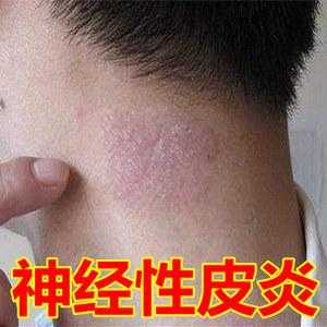 孕期神经性皮炎怎么办(神经性皮炎是什么原因引起的,用什么药最好) 第2张 孕期神经性皮炎怎么办(神经性皮炎是什么原因引起的,用什么药最好) 第2张