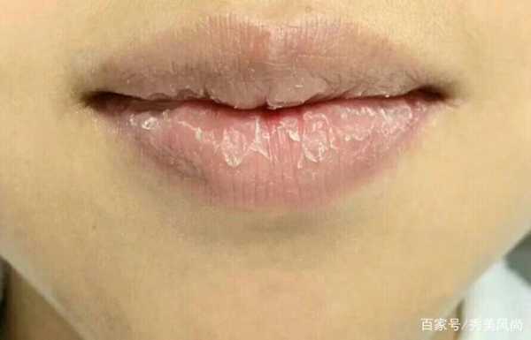 孕期嘴唇脱皮(嘴唇脱皮是怎么回事,嘴唇脱皮是缺什么) 第1张 孕期嘴唇脱皮(嘴唇脱皮是怎么回事,嘴唇脱皮是缺什么) 第1张