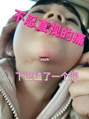 宝宝下巴磕下去一块肉怎么处理,胎儿下巴尖是男是女 第2张 宝宝下巴磕下去一块肉怎么处理,胎儿下巴尖是男是女 第2张