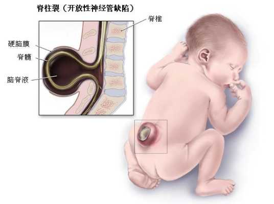 正常胎儿脊柱图片(什么是胎儿脊柱裂) 第1张 正常胎儿脊柱图片(什么是胎儿脊柱裂) 第1张