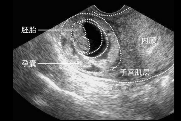 什么是孕囊?孕囊的作用是什么,胎儿发育胎囊图片 第1张 什么是孕囊?孕囊的作用是什么,胎儿发育胎囊图片 第1张