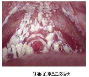 怀孕了白带有什么变化吗,孕期分泌物是什么样的图片 第3张 怀孕了白带有什么变化吗,孕期分泌物是什么样的图片 第3张