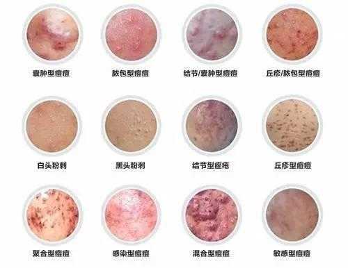 孕期痘痘(孕期痘痘反反复复长的原因是什么) 第1张 孕期痘痘(孕期痘痘反反复复长的原因是什么) 第1张