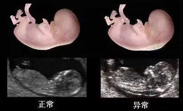 胎儿排畸（胎儿排畸检查有哪些）  第2张