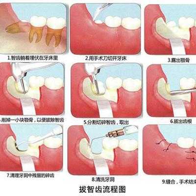 备孕期间可以拔智齿吗,怀孕期间能拔智齿吗用麻醉药品吗 第1张 备孕期间可以拔智齿吗,怀孕期间能拔智齿吗用麻醉药品吗 第1张