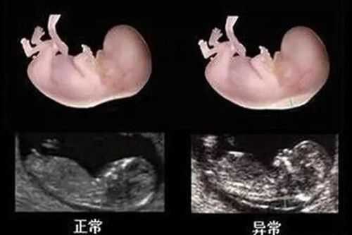 怀孕12周胎儿(怀孕12周了孩子小怎么回事) 第2张 怀孕12周胎儿(怀孕12周了孩子小怎么回事) 第2张