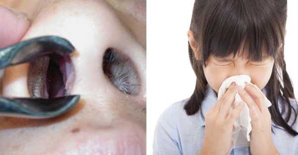 孕期有过敏性鼻炎,鼻炎影响胎儿发育吗 第2张 孕期有过敏性鼻炎,鼻炎影响胎儿发育吗 第2张
