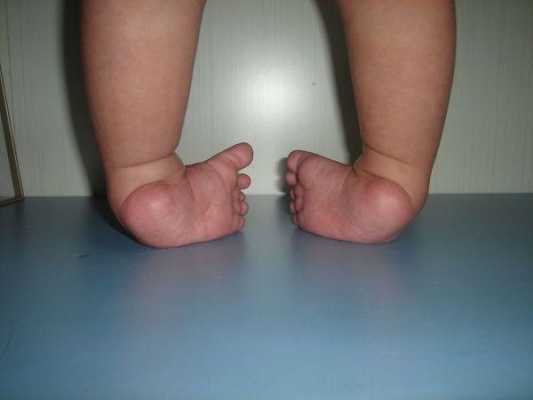 胎儿内翻足(胎儿内翻足在肚子里会好吗) 第2张 胎儿内翻足(胎儿内翻足在肚子里会好吗) 第2张