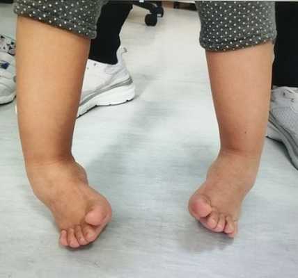 胎儿内翻足(胎儿内翻足在肚子里会好吗) 第1张 胎儿内翻足(胎儿内翻足在肚子里会好吗) 第1张