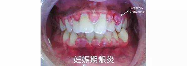 孕期牙龈出血是怎么回事(孕期牙龈出血是怎么回事儿) 第1张 孕期牙龈出血是怎么回事(孕期牙龈出血是怎么回事儿) 第1张