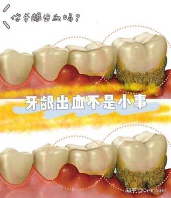 孕期牙龈出血是怎么回事(孕期牙龈出血是怎么回事儿) 第3张 孕期牙龈出血是怎么回事(孕期牙龈出血是怎么回事儿) 第3张