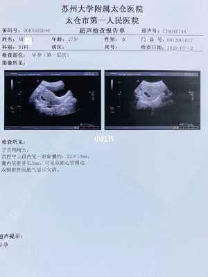 怀孕两个月后发现甲低,对婴儿有聋哑有影响吗,聋哑胎儿能检查出来吗 第3张 怀孕两个月后发现甲低,对婴儿有聋哑有影响吗,聋哑胎儿能检查出来吗 第3张