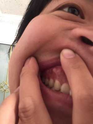 孕期牙龈增生怎么办(孕期牙龈增生怎么办) 第2张 孕期牙龈增生怎么办(孕期牙龈增生怎么办) 第2张