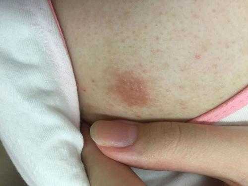 怀孕后乳头总是发痒,这是怎么回事呢,怀孕期间乳头痒怎么回事啊 第1张 怀孕后乳头总是发痒,这是怎么回事呢,怀孕期间乳头痒怎么回事啊 第1张