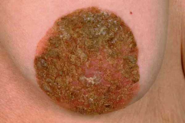 怀孕后乳头总是发痒,这是怎么回事呢,怀孕期间乳头痒怎么回事啊 第2张 怀孕后乳头总是发痒,这是怎么回事呢,怀孕期间乳头痒怎么回事啊 第2张