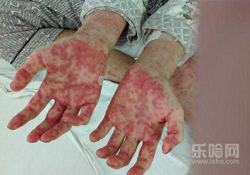 孕期白血病（孕期白血病有什么症状）  第1张