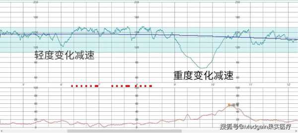 胎儿脉搏(胎儿脉搏) 第1张 胎儿脉搏(胎儿脉搏) 第1张