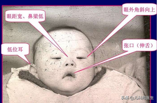 什么叫三体综合症,胎儿综合症有哪些 第2张 什么叫三体综合症,胎儿综合症有哪些 第2张