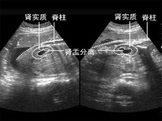 胎儿双肾盂未见分离(双肾盂无分离是什么意思) 第3张 胎儿双肾盂未见分离(双肾盂无分离是什么意思) 第3张