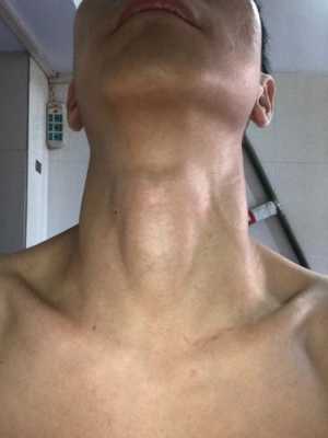 在喉结纹一条线叫什么,胎儿颈部见u型切迹是什么意思? 第1张 在喉结纹一条线叫什么,胎儿颈部见u型切迹是什么意思? 第1张